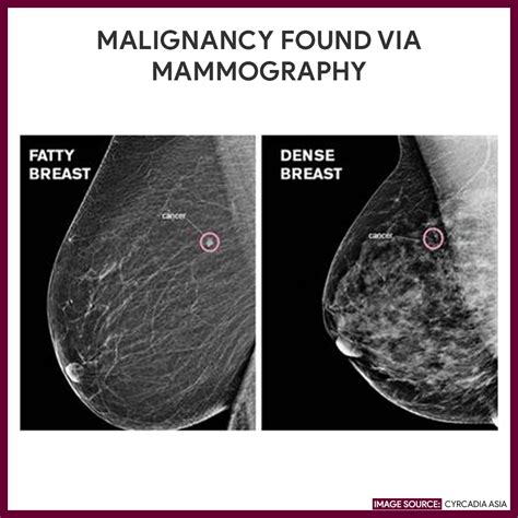 unable to do breast cancer test due to hard implants|breast implants on cancer mammogram.